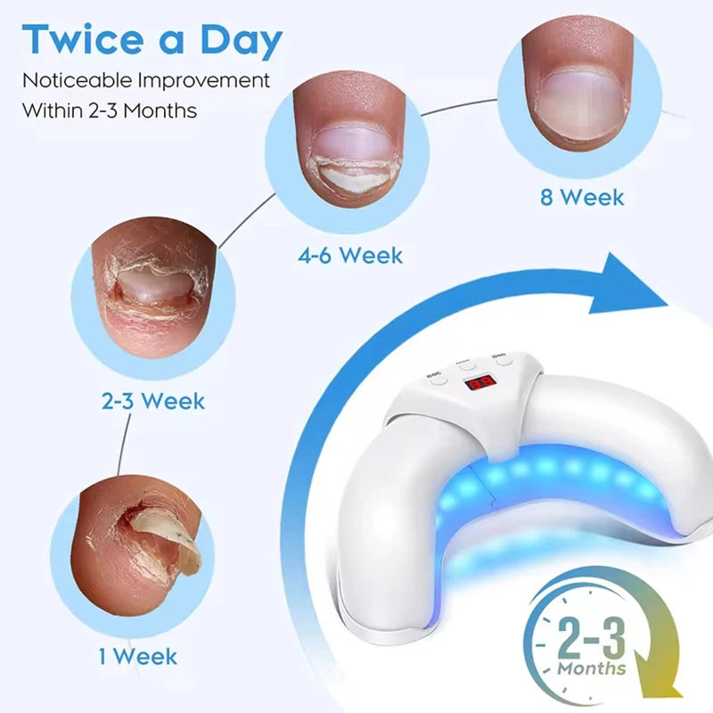 Toenail/Fingernail Fungal Repair Laser Device