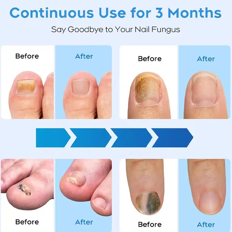 Toenail/Fingernail Fungal Repair Laser Device